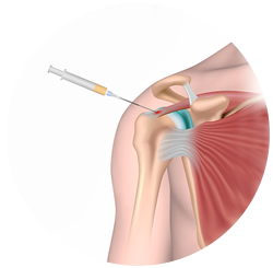 PRP Orthopedic Injection Specialist Bay Area